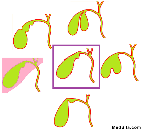 Обычный желчный пузырь и варианты его строения.
